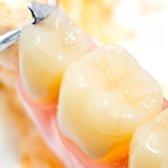 dondiadents_multicouche Multicouche