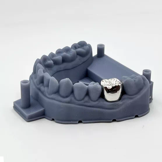 Couronne bridge metal