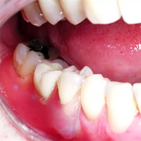 appareil_valplast appareil valplast