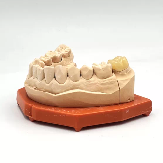 Couronnes impression 3d